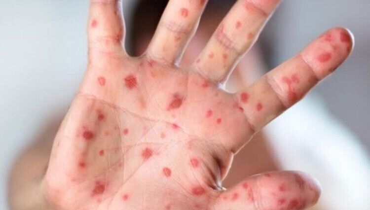 حذف سرخک و سرخجه در ایران/تبریک مدیر منطقه‌ای سازمان جهانی بهداشت به وزیر بهداشت
